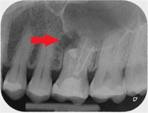 Periapical Abscess Radiograph