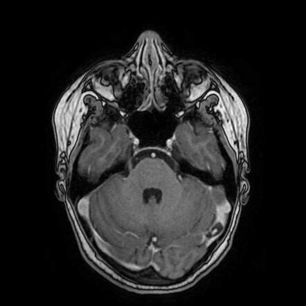 Arachnoid granulation with central enhancing vein | Radiology Case | Radiopaedia.org