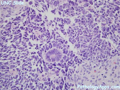 wilms tumor pathology