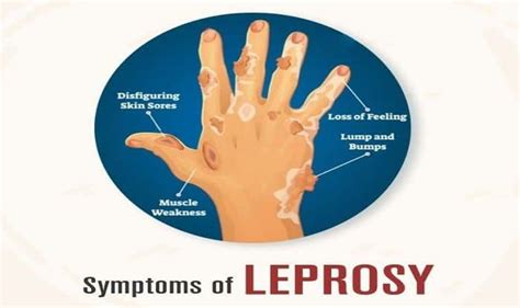 Leprosy – Santripty