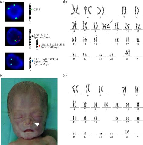 Double Trisomy