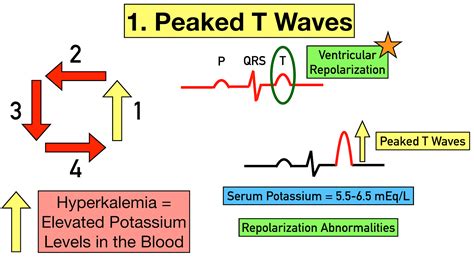 Hyperkalemia Ecg Interpretation Hyperkalemia Ekg Interpretation Sexiz Pix | The Best Porn Website