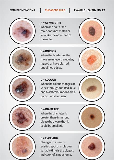 Melanoma – Artofit