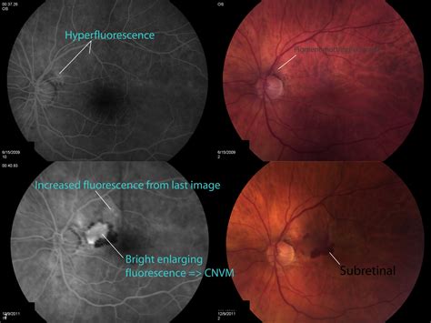 FUNdus exams: Wet AMD with new subretinal hemorrhage