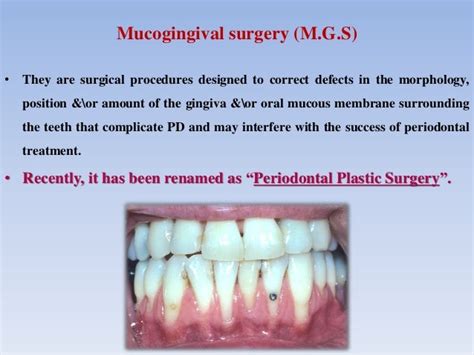 Mucogingival surgery