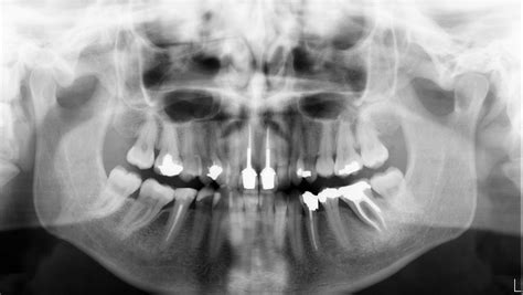 How often are xrays taken and why? – OPG | Seymour Dental - Dedicated personal care