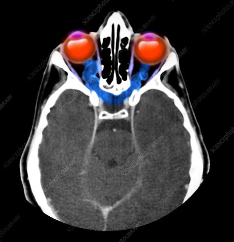 Optic Nerve Tumors - Stock Image - M220/0179 - Science Photo Library