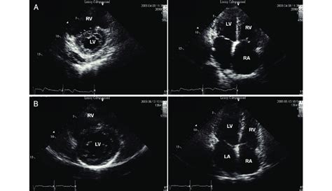 Echocardiography in a patient with isolated pulmonary arterial... | Download Scientific Diagram