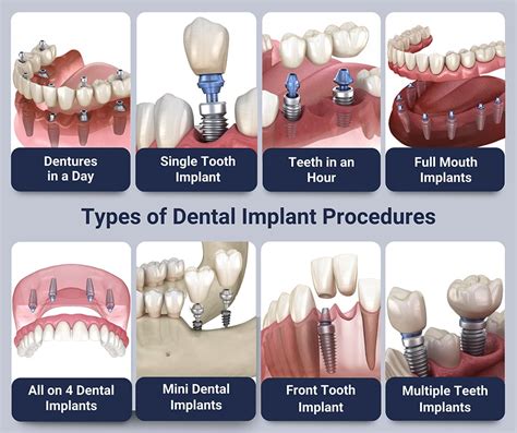 Dental Implants Procedures | NYC Dental Implants Center