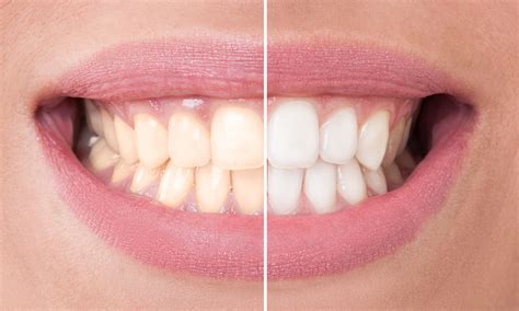 Do Teeth-Whitening Kits You Use at Home Really Work? – Health Essentials from Cleveland Clinic