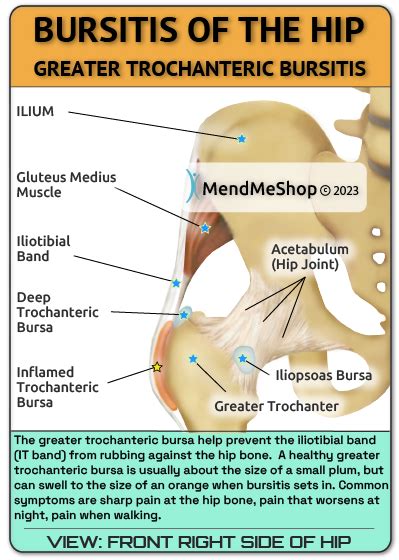 Trochanteric Hip Bursitis: Symptoms Causes Diagnosis Treatment