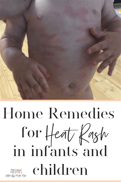 5 Best Home Remedies for Baby Heat Rash - Naturally Made Mom