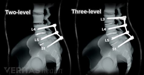 Multilevel Spinal Fusion for Low Back Pain