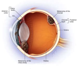 Eye Cancer - Eye Uveal Melanoma - Smart Laser Eye Center