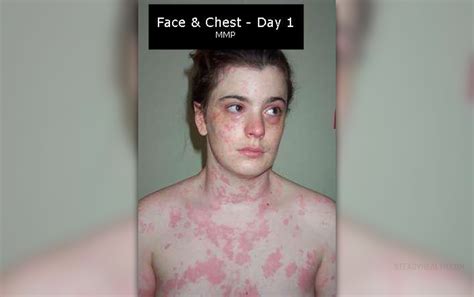 Causes of chronic hives | Skin & Hair problems articles | Body & Health Conditions center ...