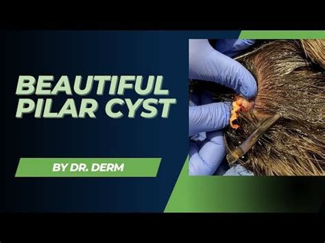 Dr. Derm - Pilar Cyst Removal : r/Popping_Curated