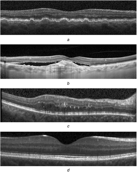 Examples of SD‐OCT images (a) Dry AMD, (b) Wet AMD, (c) DME and, (d)... | Download Scientific ...