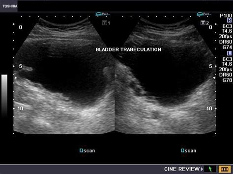 A Gallery of High-Resolution, Ultrasound, Color Doppler & 3D Images - Urinary bladder