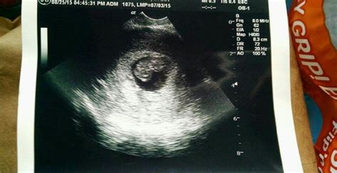 8 weeks pregnant. Saw heartbeat on the 25th second ultrasound on 27th ...