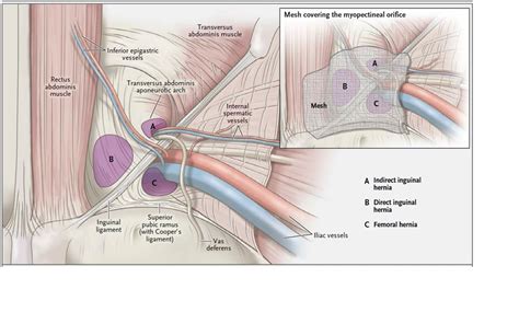 Types of Hernias | The Hernia Clinic