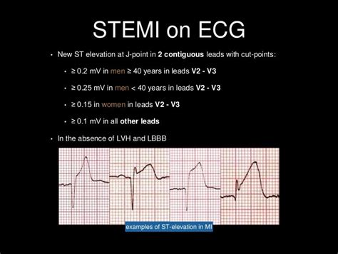 Stemi criteria