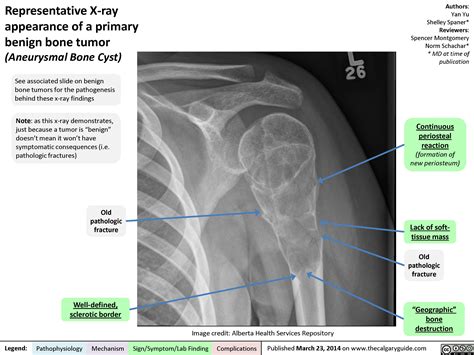 Representative X-ray appearance of a primary benign bone tumor ...