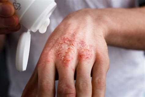 Keep Your Eczema Under Control With These Quick Tips - The Best Of Health