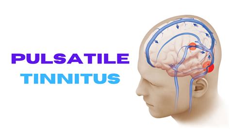 Pulsatile Tinnitus: Understanding Symptoms And Treatment Options