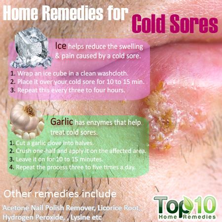 Home Remedies for Cold Sores | Top 10 Home Remedies