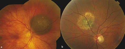 Choroidal Nevus | Ento Key