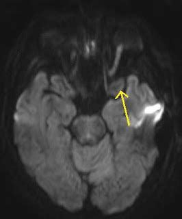 Optic Neuritis-MRI - Sumer's Radiology Blog