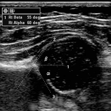 normal-infant-hip-ultrasound - Don't Forget the Bubbles