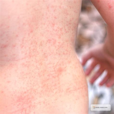 Natural Remedies for Heat Rash in Children