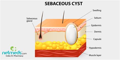 How To Prevent Sebaceous Cysts - Sonmixture11