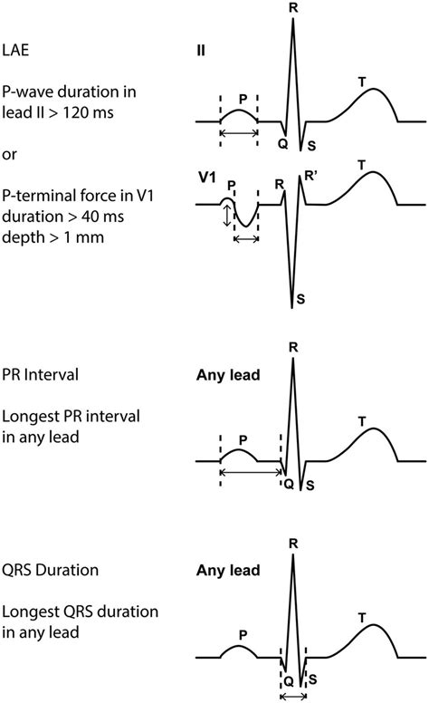 12-lead ECG measurements. Measurement of the PR interval, QRS duration,... | Download Scientific ...