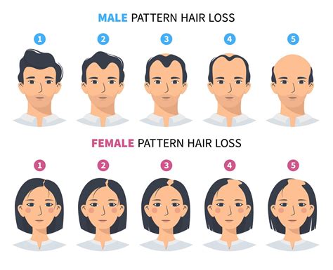 Hair loss stages, androgenetic alopecia male and female pattern. Steps of baldness vector ...