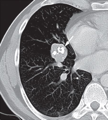 Tumors of the Lung | Radiology Key