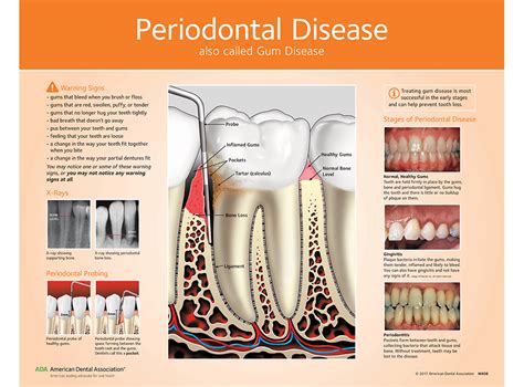 ADA Store - Periodontal (Gum) Disease Chart