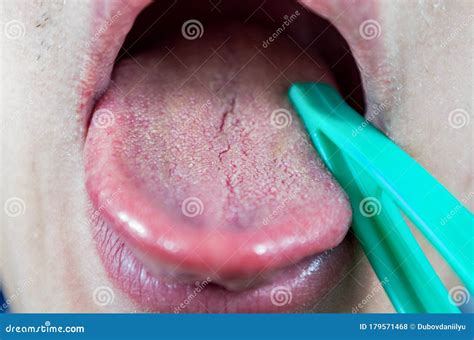 Examination Of The Human Tongue Organ, Diseases And Manifestations Of ...