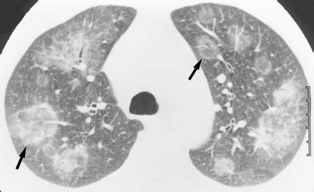 Borborygmus: Cryptogenic Organizing Pneumonia