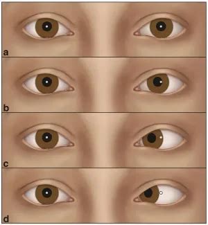 Corneal light reflex - American Academy of Ophthalmology