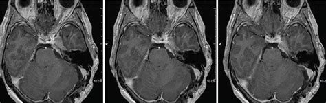 Cavernous sinus/petroclival meningioma – immediate postoperative radiosurgery for residual ...