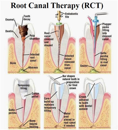 Root canal treatment (endodontic treatment) explained | News | Dentagama