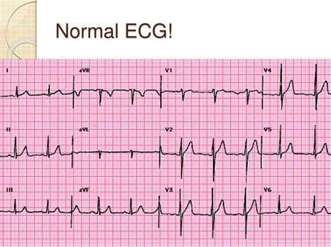 Ecg Interpretation | Images and Photos finder