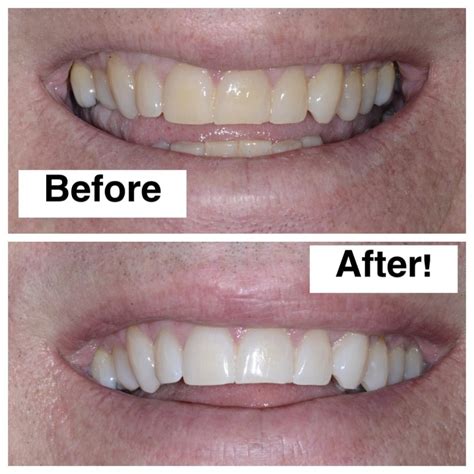 Discover Zoom Teeth Whitening at North Seattle Dental