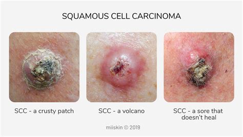 [DIAGRAM] Diagram Of Squamous Cell Carcinoma - MYDIAGRAM.ONLINE