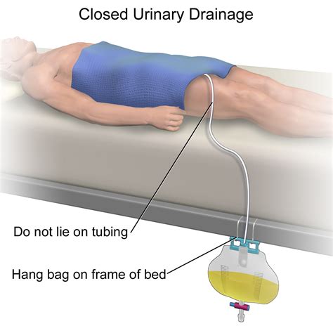 Emptying Catheter Drainage Bag at David Hyde blog