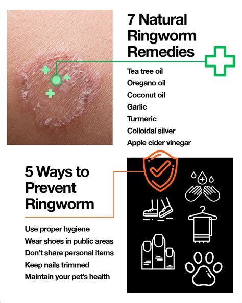 Got Ringworm? We’ve Got the Causes, Symptoms and Remedies – The Amino Company