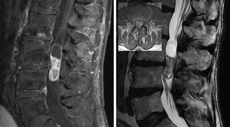 Extramedullary Spinal Cord Tumor | The Neurosurgical Atlas, by Aaron Cohen-Gadol, M.D.