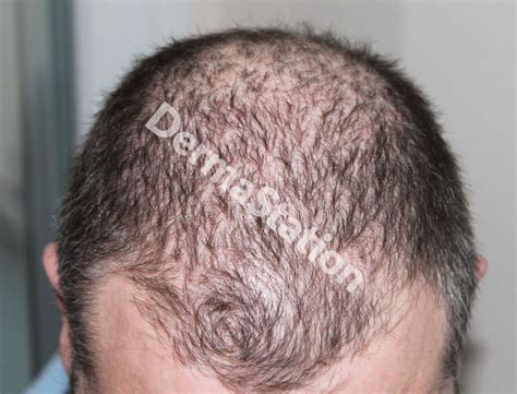 Androgenetic Alopecia (Pattern Hair Loss)